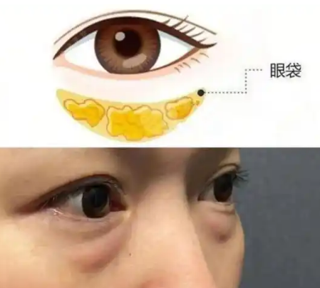 眼袋