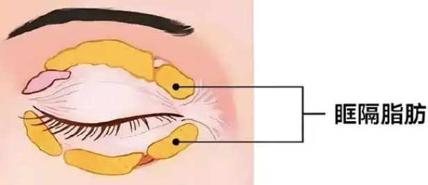 眼袋