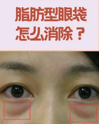 眼袋