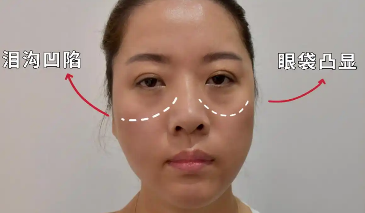 眼袋