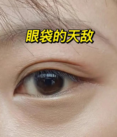 眼袋