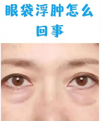 眼袋