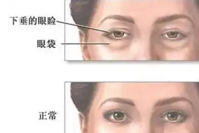 眼袋
