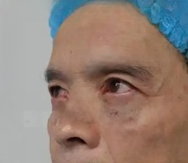 去眼袋手术