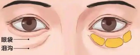 去眼袋手术
