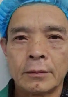 去眼袋手术