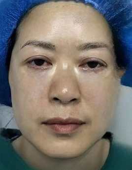 去眼袋手术
