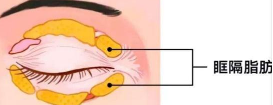去眼袋手术