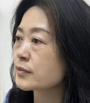 去眼袋手术
