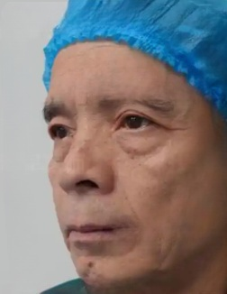 去眼袋手术