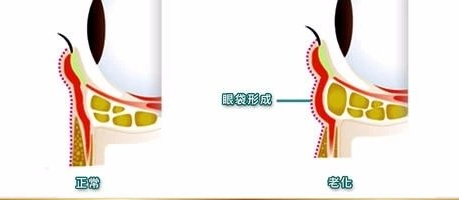 去眼袋手术