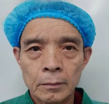 去眼袋手术