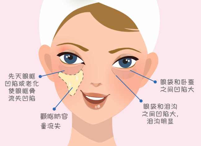 去眼袋手术