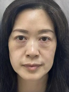 去眼袋手术