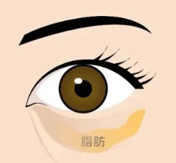 去眼袋手术