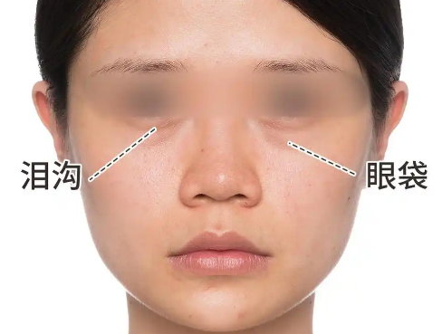 去眼袋手术