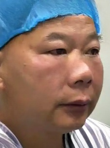 去眼袋手术