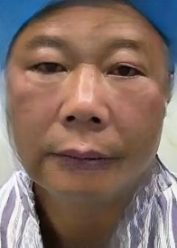 去眼袋手术