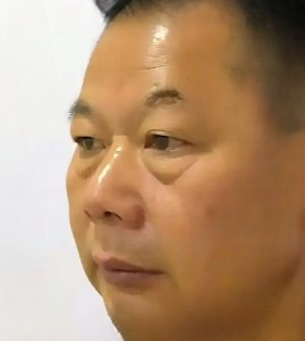 去眼袋手术
