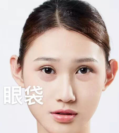 去眼袋手术