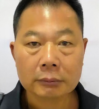 去眼袋手术