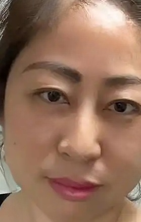 去眼袋手术