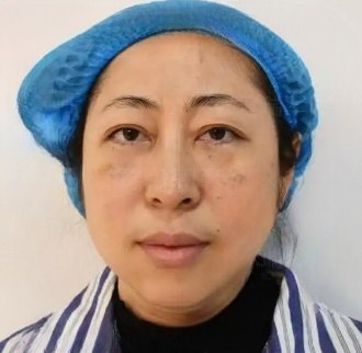 去眼袋手术