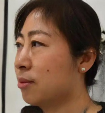去眼袋手术