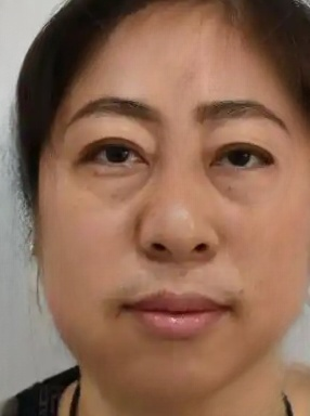 去眼袋手术