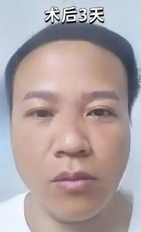 去眼袋手术
