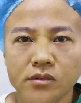去眼袋手术