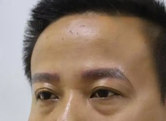 去眼袋手术
