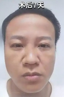 去眼袋手术