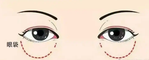 去眼袋手术