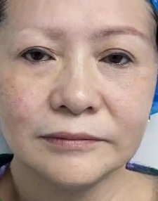 去眼袋手术
