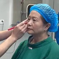去眼袋手术