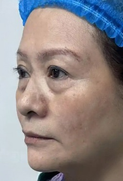 去眼袋手术