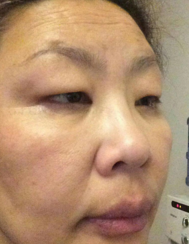 去眼袋手术