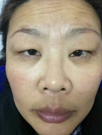 去眼袋手术