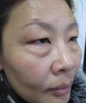 去眼袋手术