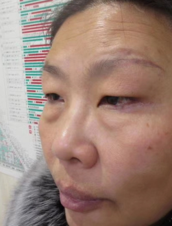 去眼袋手术