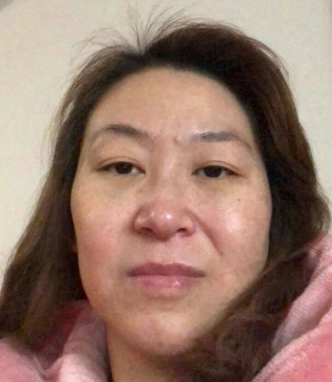 去眼袋手术