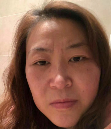 去眼袋手术