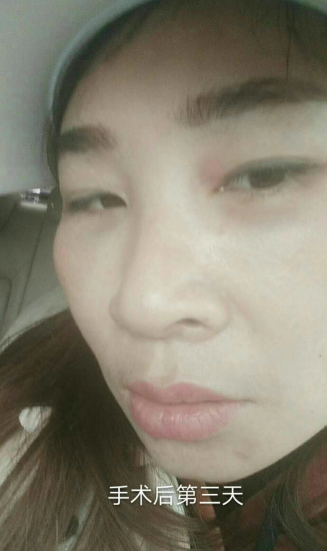 去眼袋手术