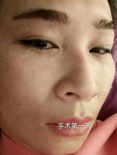 去眼袋手术
