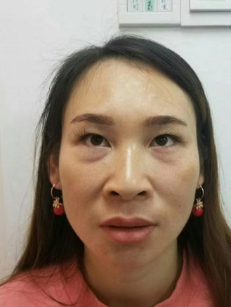去眼袋手术