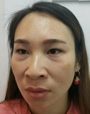 去眼袋手术