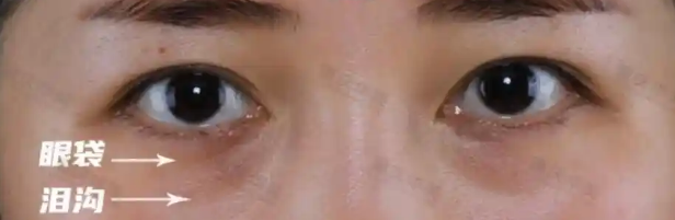 去眼袋手术