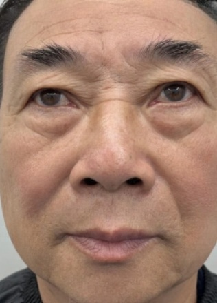 去眼袋手术
