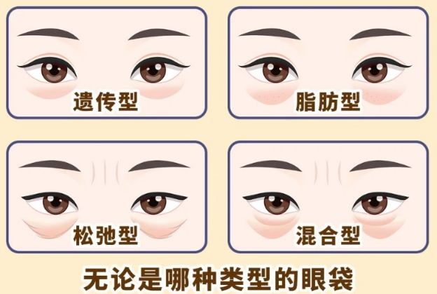 去眼袋手术